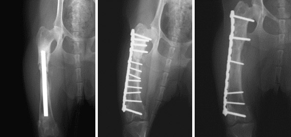 不適切な髄内ピン手術により大腿骨癒合不全に陥った症例